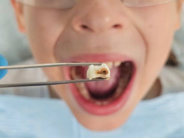 Best Emergency Wisdom Teeth Removal in USA